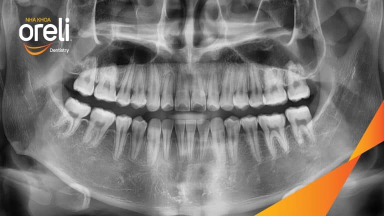 Ca niềng răng sai khớp cắn hạng 3 móm chen chúc kèm di gần răng số 7 8 thay thế răng 6 ở Oreli