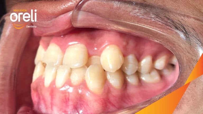 Ca niềng răng sai khớp cắn hạng 3 móm chen chúc kèm di gần răng số 7 8 thay thế răng 6 ở Oreli