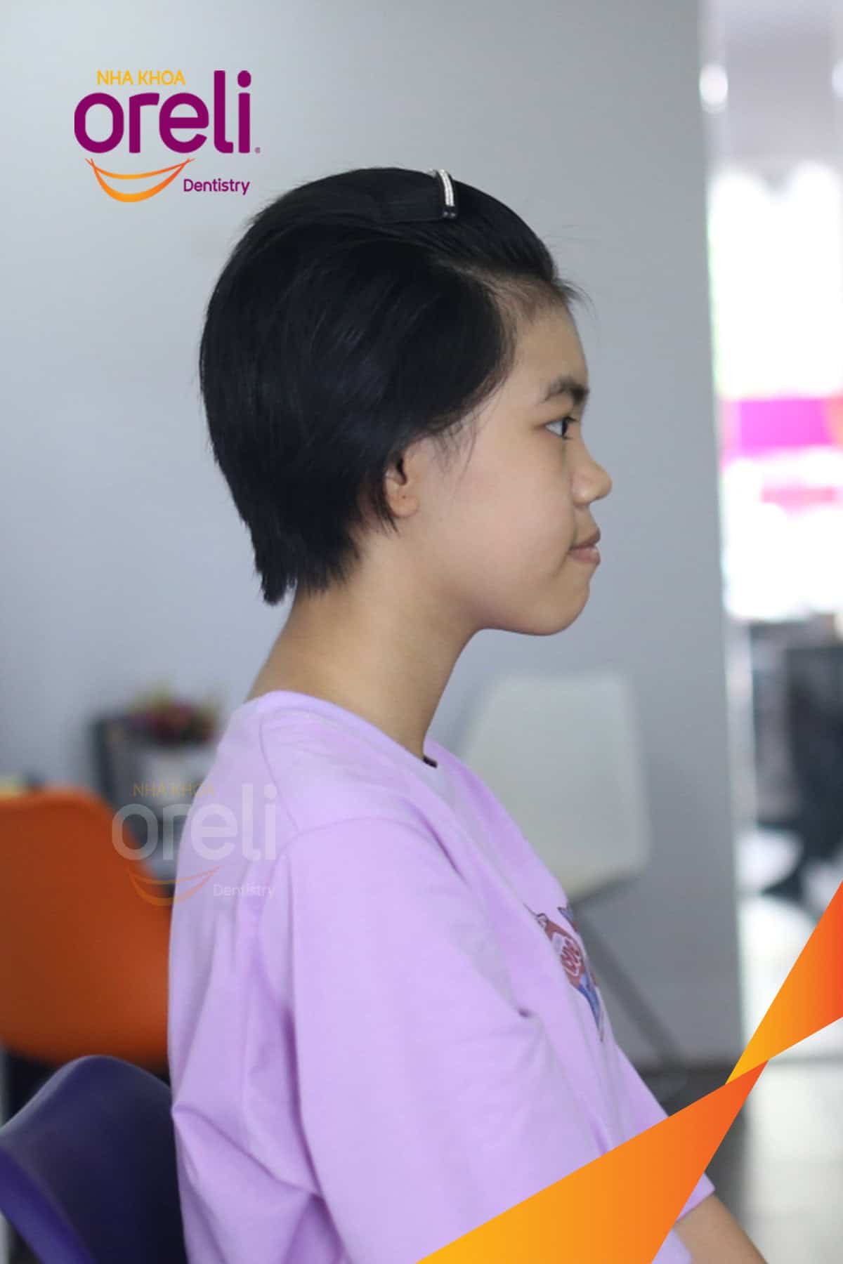 Răng hô trước khi niềng