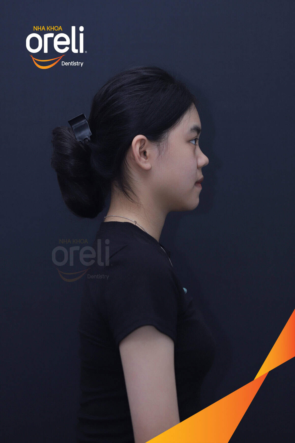 Răng sau khi niềng tại Oreli