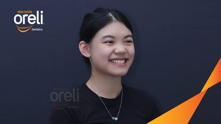 Ca niềng chỉnh hô cho nụ cười đẹp chuẩn smile design ở Oreli