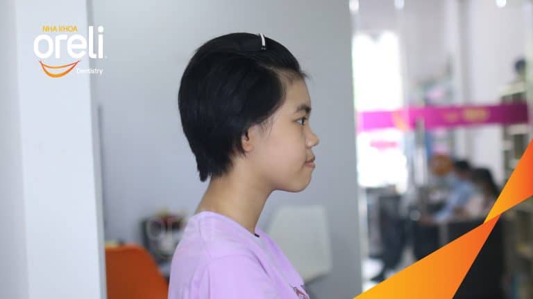 Ca niềng chỉnh hô cho nụ cười đẹp chuẩn smile design ở Oreli