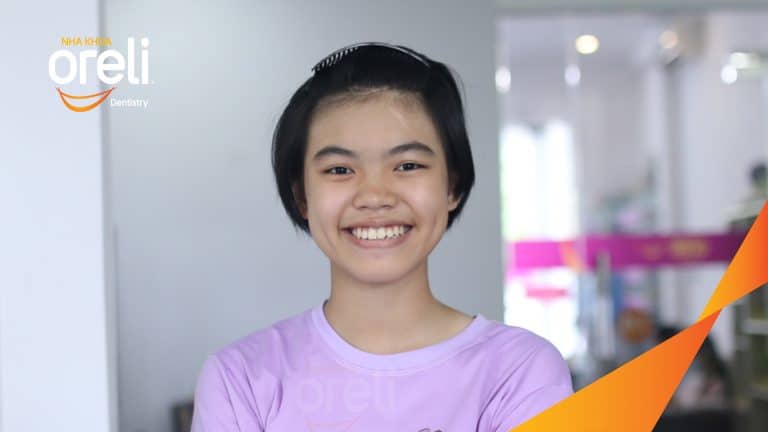 Ca niềng chỉnh hô cho nụ cười đẹp chuẩn smile design ở Oreli