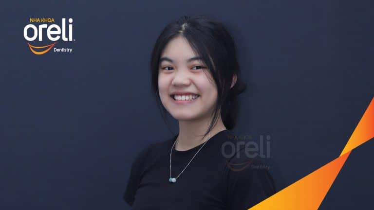 Ca niềng chỉnh hô cho nụ cười đẹp chuẩn smile design ở Oreli