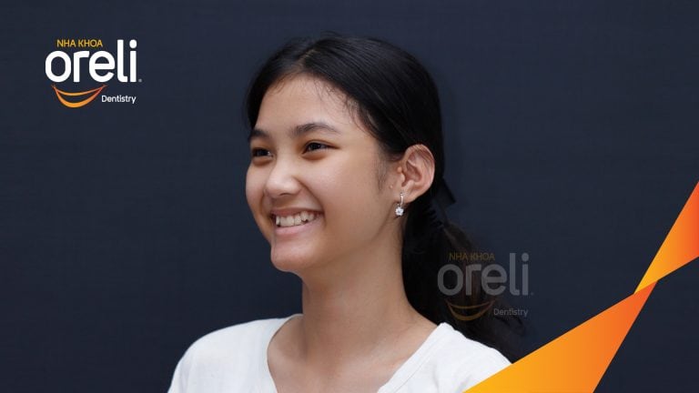 Niềng chỉnh răng chen chúc hai hàm – Kết quả thực tế sau 18 tháng tại Oreli