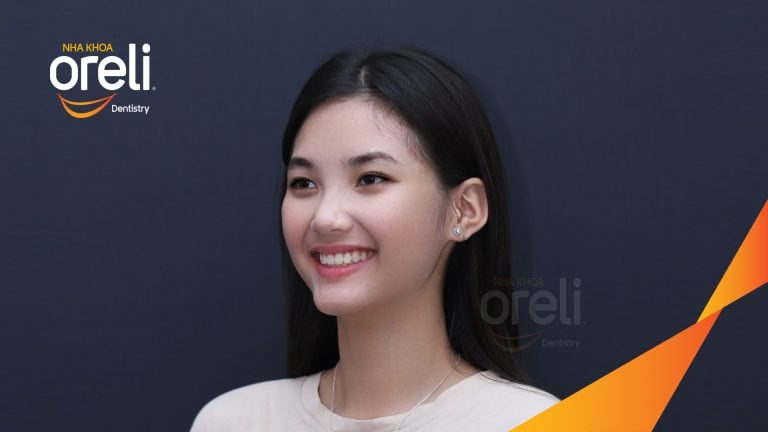 Niềng chỉnh răng chen chúc hai hàm – Kết quả thực tế sau 18 tháng tại Oreli