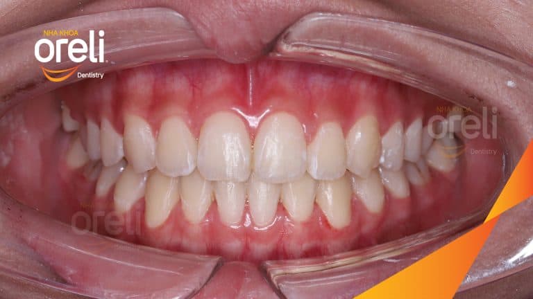 Niềng chỉnh răng chen chúc hai hàm – Kết quả thực tế sau 18 tháng tại Oreli