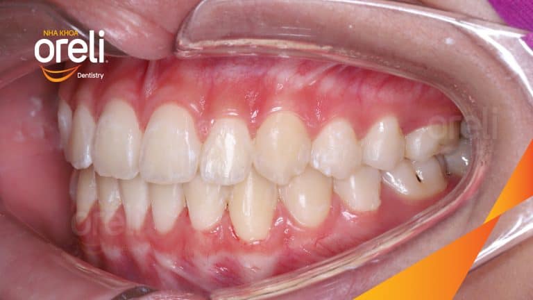Niềng chỉnh răng chen chúc hai hàm – Kết quả thực tế sau 18 tháng tại Oreli