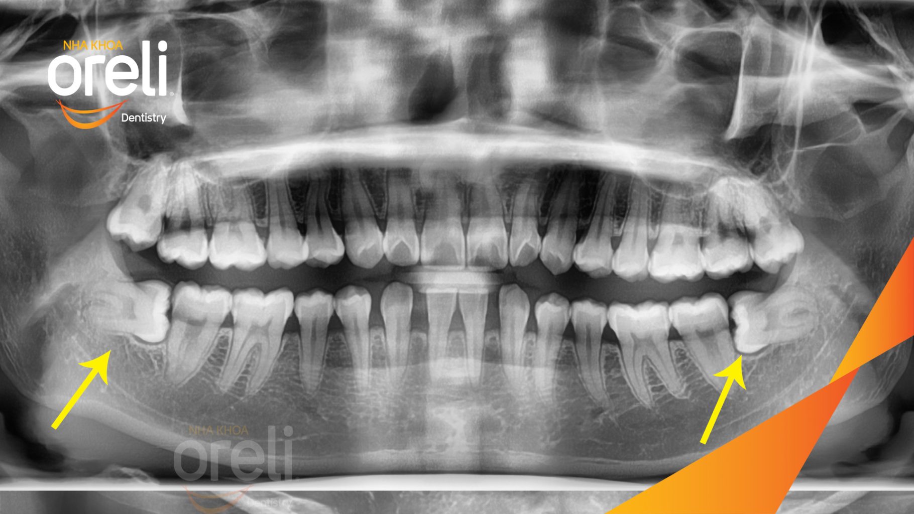 Trước điều trị: Răng khôn hàm dưới mọc lệch ngang 90 độ tại Nha khoa Oreli