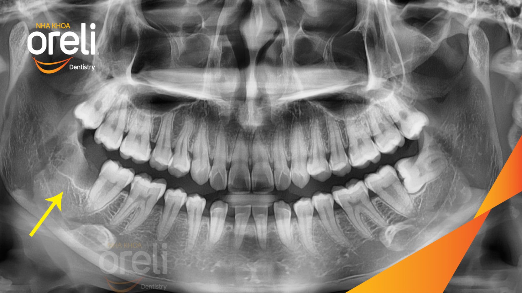 Răng khôn hàm dưới mọc lệch ngang 90 độ trước khi điều trị tại Nha khoa Oreli