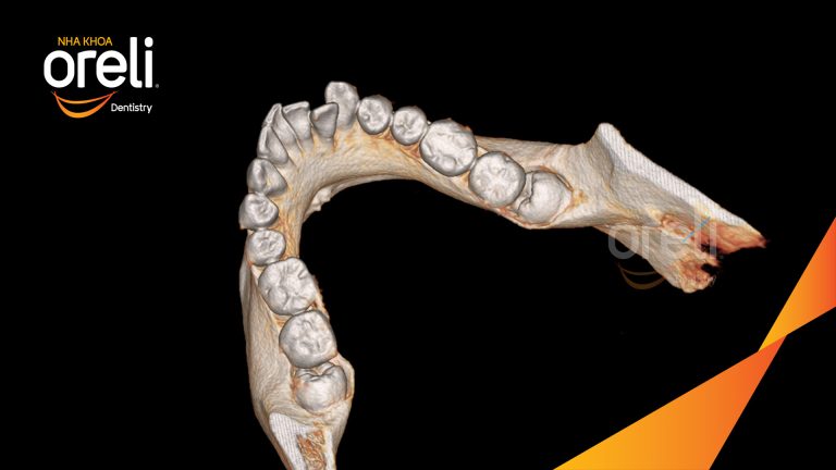 Nhổ răng khôn hàm dưới khó – Kết quả sau điều trị tại Oreli