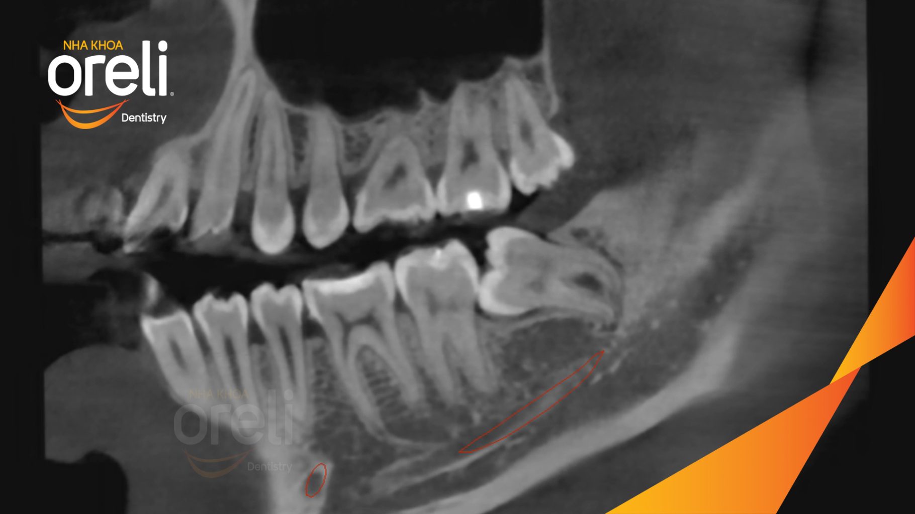 Răng khôn hàm dưới bên trái lệch trước khi điều trị tại Nha khoa Oreli