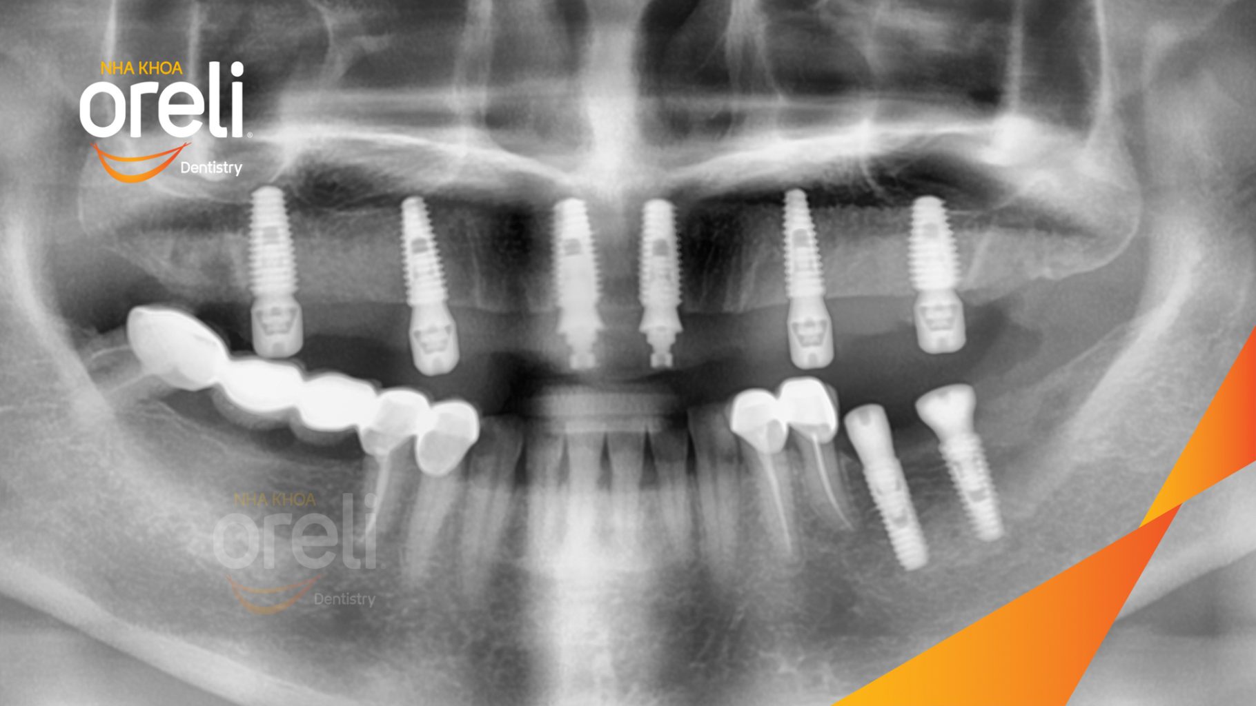 Cầu răng sứ hàm trên lâu ngày gãy, viêm nướu, chân răng lung lay trước khi điều trị tại Nha khoa Oreli