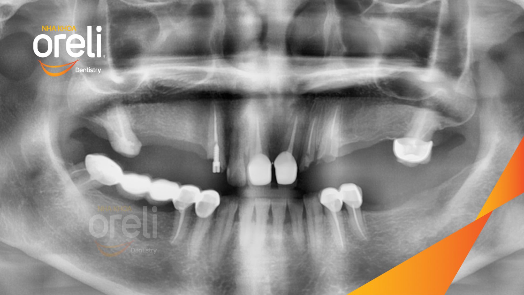 Trước điều trị: Cầu răng sứ hàm trên lâu ngày gãy, viêm nướu, chân răng lung lay tại Nha khoa Oreli