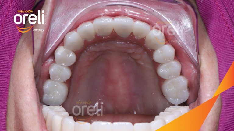 Ca trồng răng implant hàm trên cho nụ cười đẹp và ăn nhai chắc chắn ở Oreli