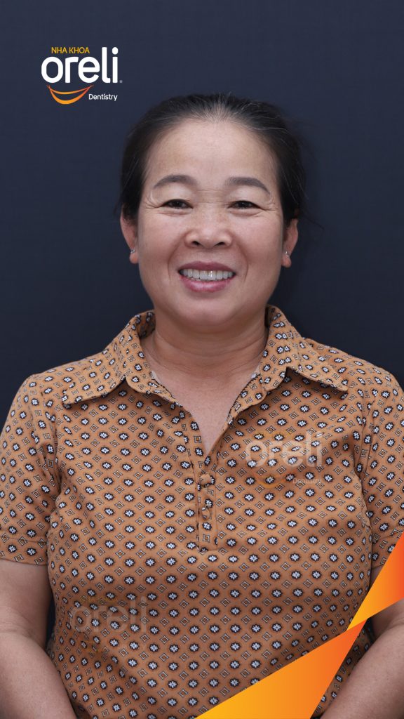 Kết quả sau 3 tháng: Phục hồi nụ cười tự nhiên và ăn nhai ổn định tại Nha khoa Oreli