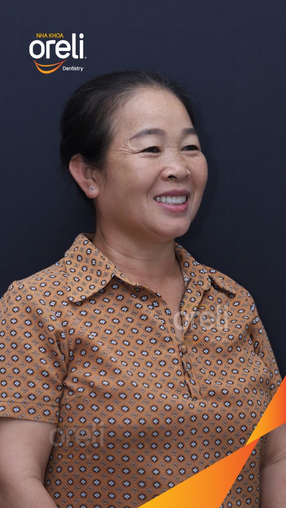 Trước điều trị: Cầu răng sứ hàm trên lâu ngày gãy, viêm nướu, chân răng lung lay tại Nha khoa Oreli