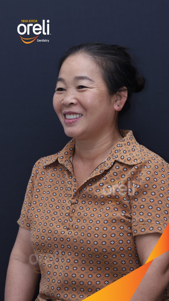 Kết quả đạt được sau 3 tháng - Phục hồi nụ cười tự nhiên và ăn nhai ổn định tại Nha khoa Oreli