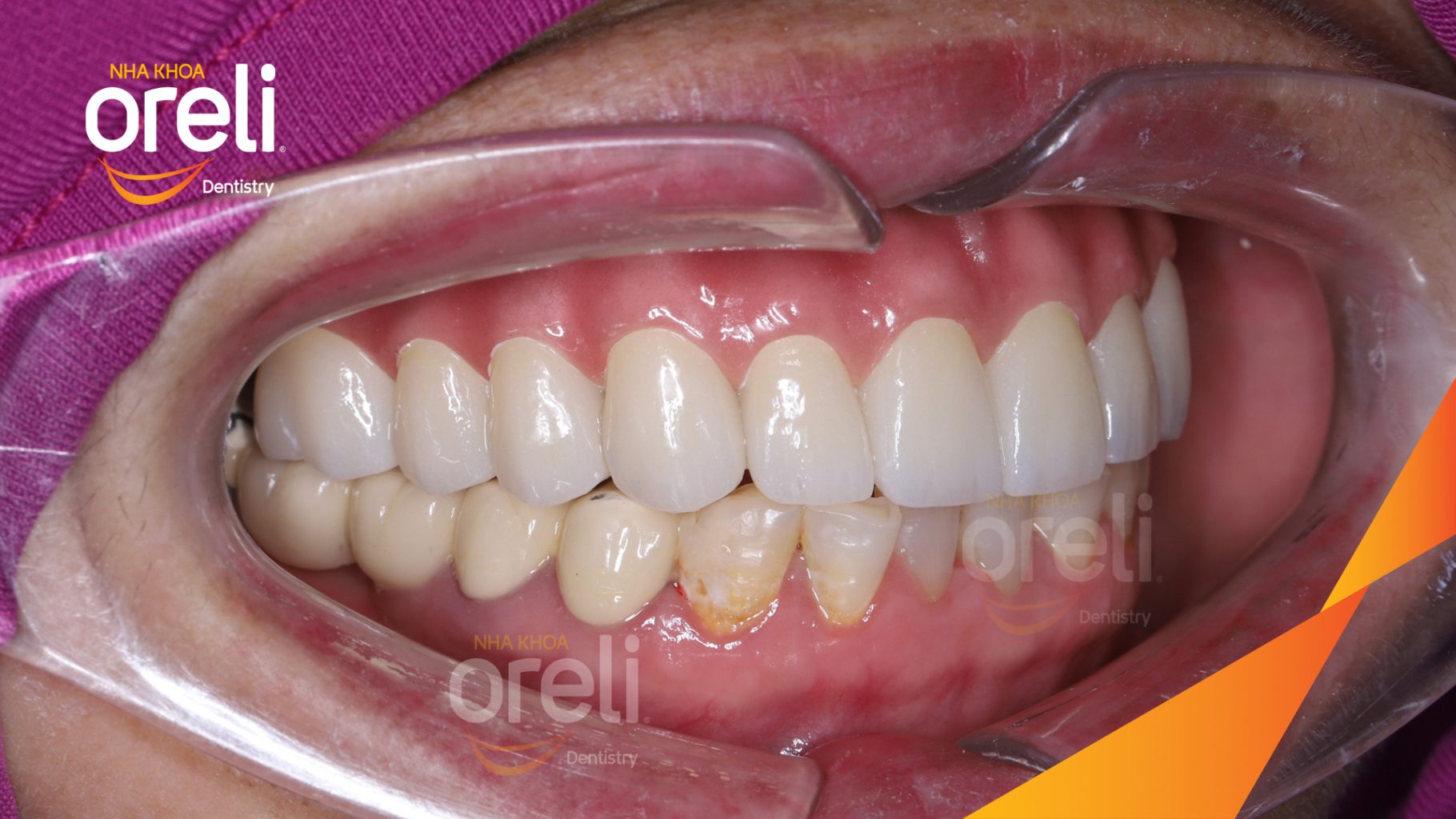 Quá trình Cắt cầu răng sứ, nhổ răng, trồng răng implant trong 3 tháng tại Nha khoa Oreli