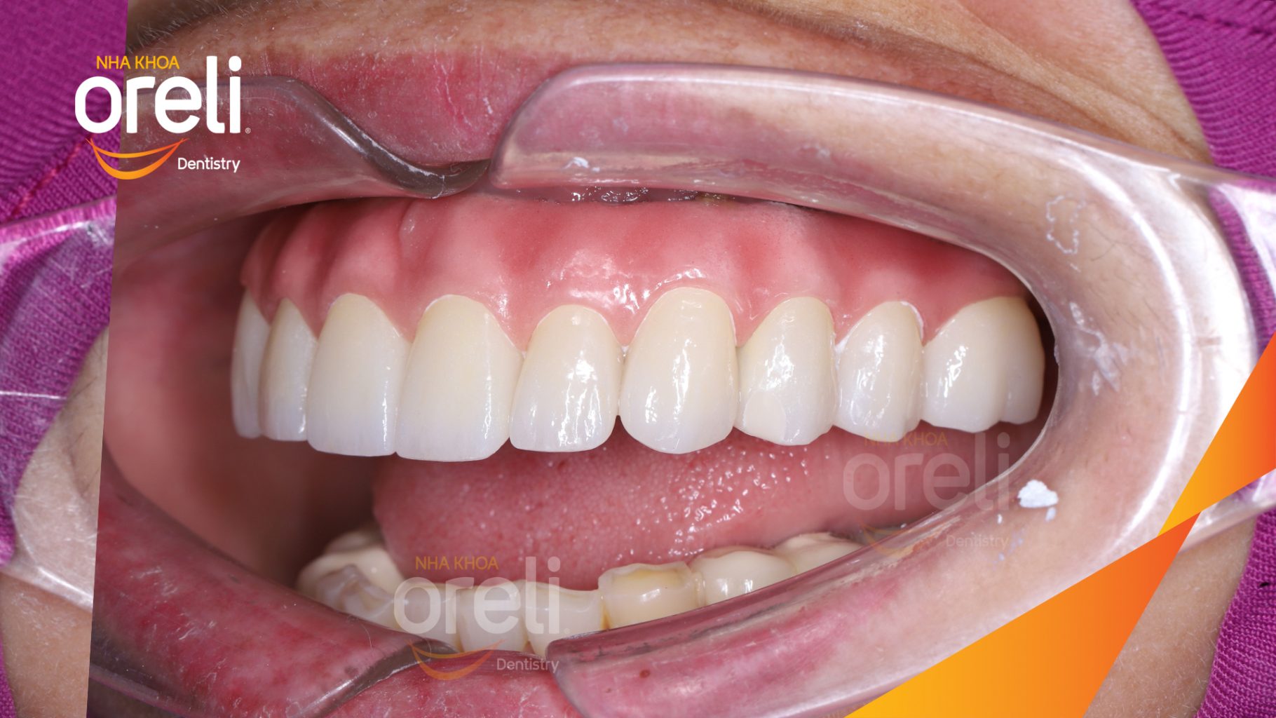 Cầu răng sứ hàm trên lâu ngày gãy, viêm nướu, chân răng lung lay trước khi điều trị tại Nha khoa Oreli