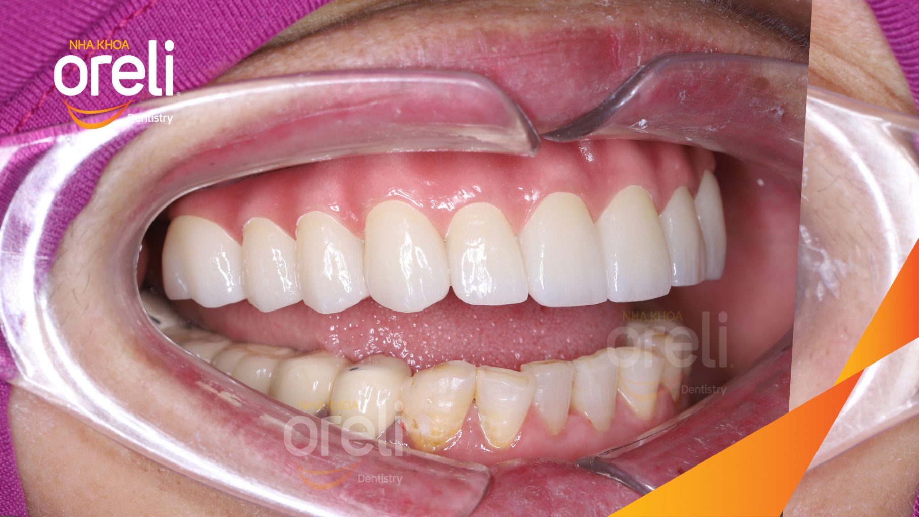 Trước điều trị: Cầu răng sứ hàm trên lâu ngày gãy, viêm nướu, chân răng lung lay tại Nha khoa Oreli