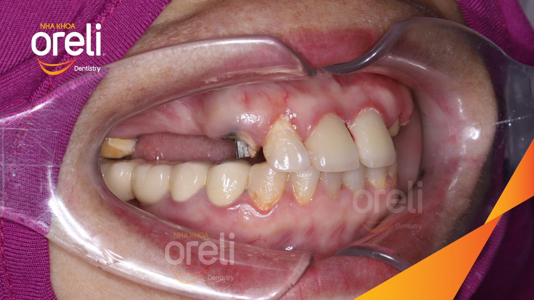 Quá trình Cắt cầu răng sứ, nhổ răng, trồng răng implant trong 3 tháng tại Nha khoa Oreli