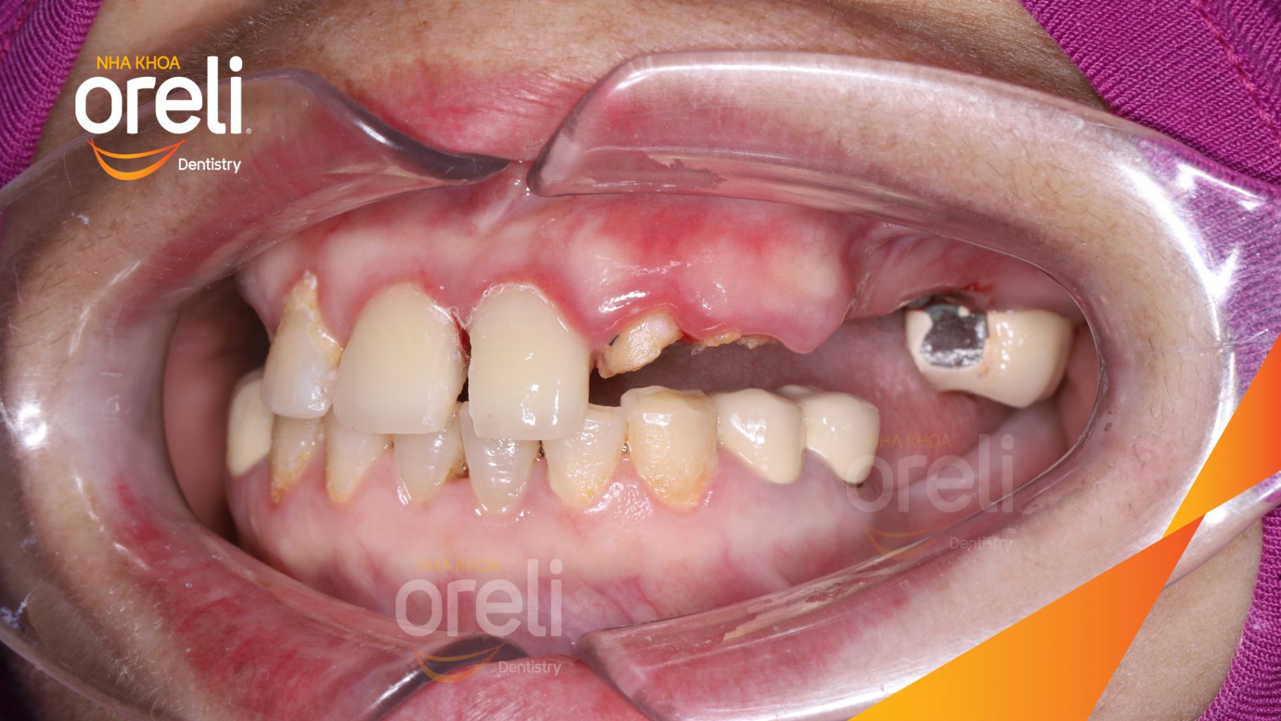 Thực hiện Cắt cầu răng sứ, nhổ răng, trồng răng implant kéo dài 3 tháng tại Nha khoa Oreli