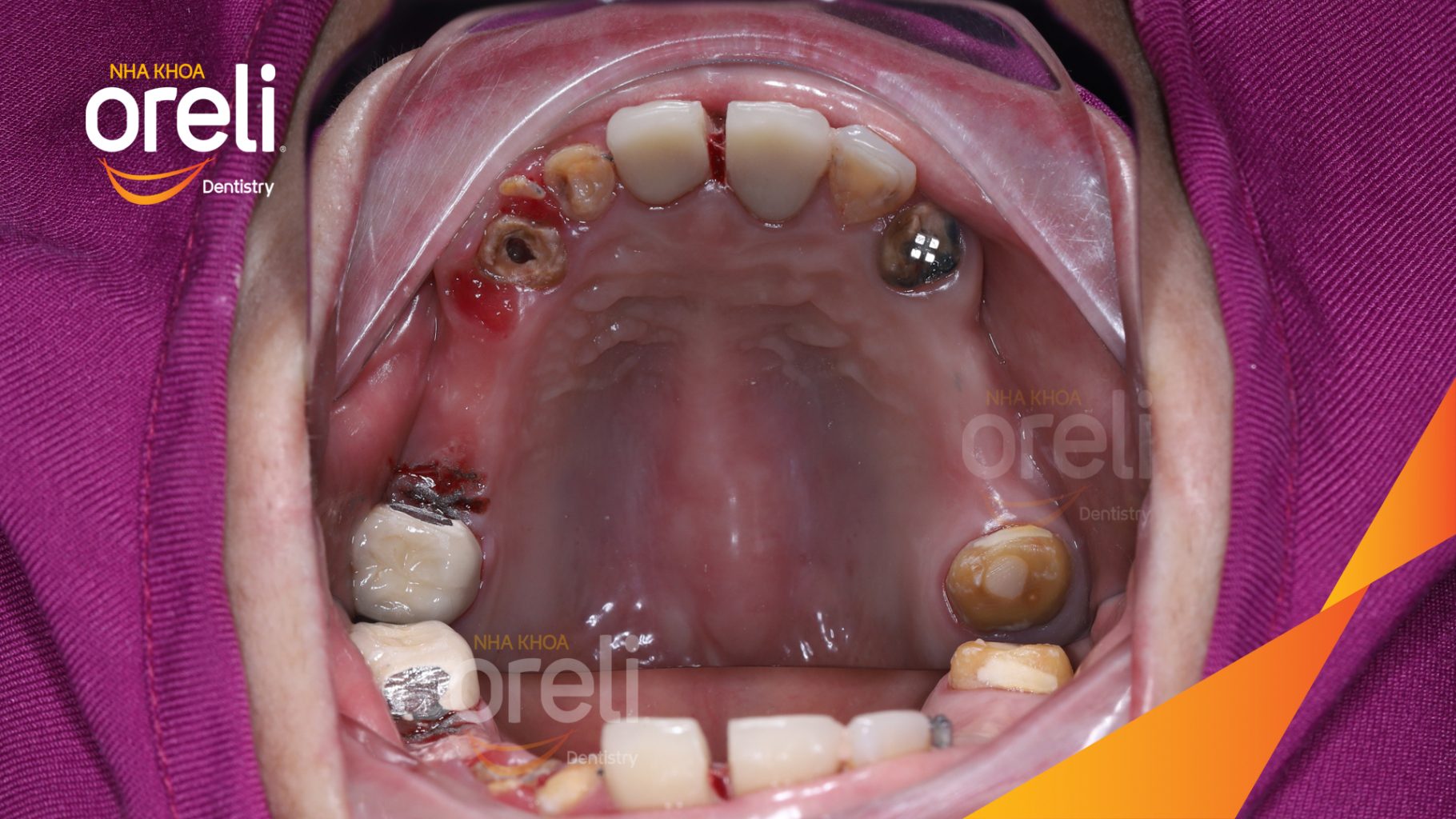 Kết quả sau 3 tháng: Phục hồi nụ cười tự nhiên và ăn nhai ổn định tại Nha khoa Oreli