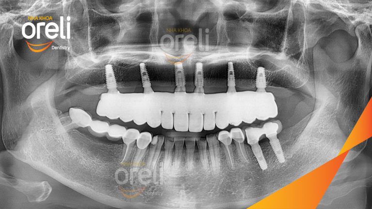Ca trồng răng implant hàm trên cho nụ cười đẹp và ăn nhai chắc chắn ở Oreli