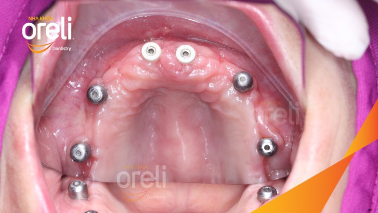 Ca trồng răng implant hàm trên cho nụ cười đẹp và ăn nhai chắc chắn ở Oreli