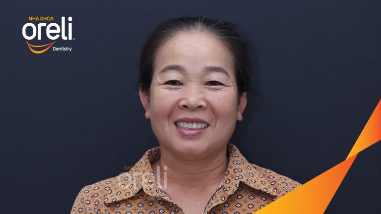 Ca trồng răng implant hàm trên cho nụ cười đẹp và ăn nhai chắc chắn ở Oreli