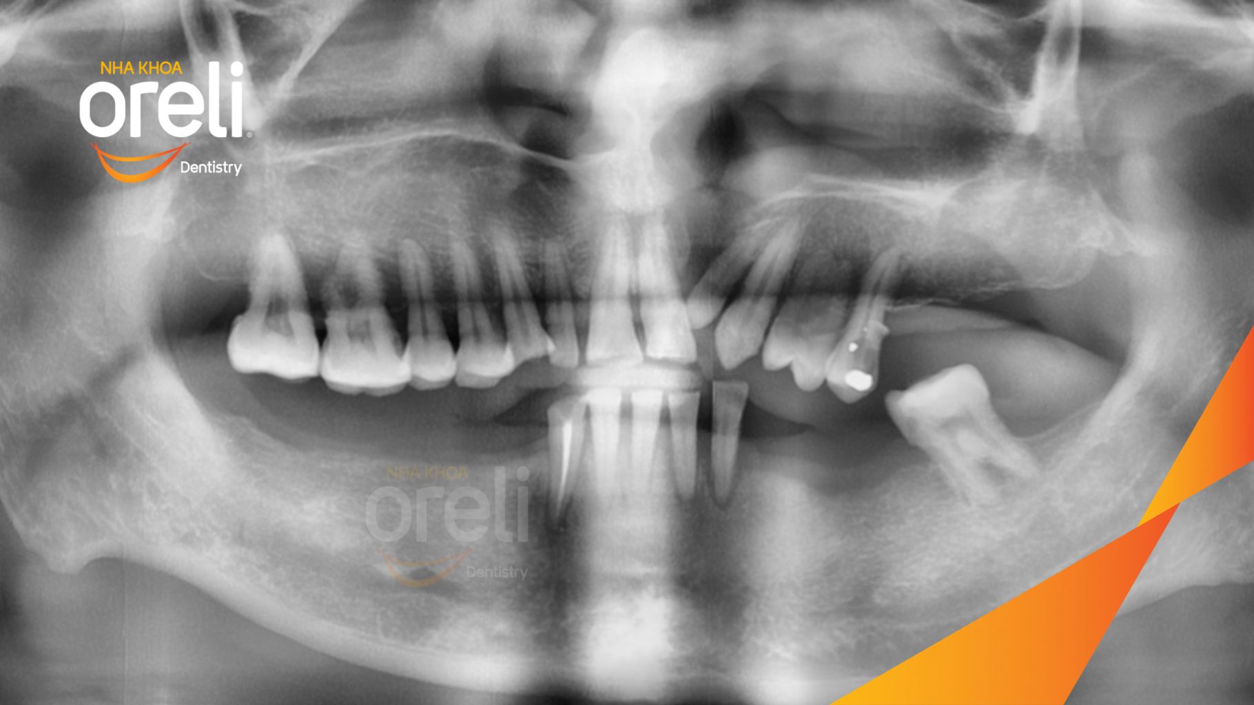 Trước điều trị: Mất răng vùng răng sau hàm dưới, các răng trước lung lay mất khả năng hồi phục tại Nha khoa Oreli Buôn Hồ