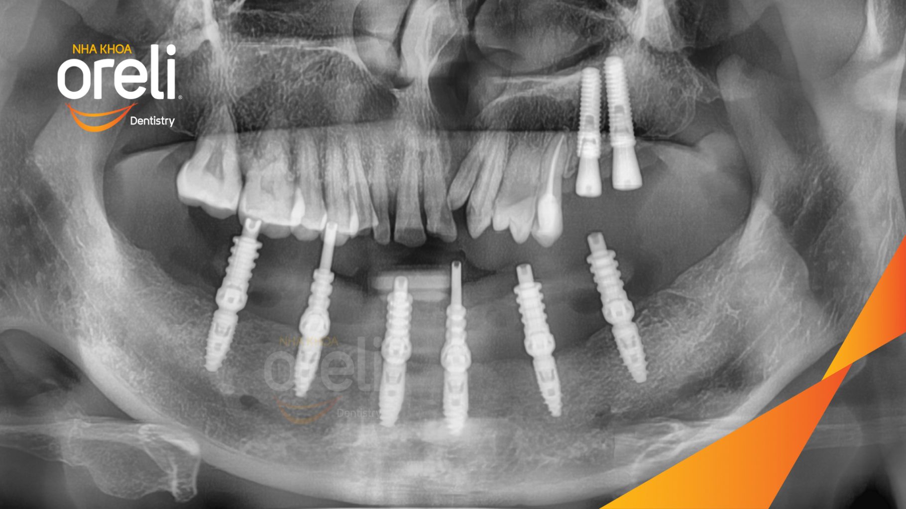 Mất răng vùng răng sau hàm dưới, các răng trước lung lay mất khả năng hồi phục trước khi điều trị tại Nha khoa Oreli Buôn Hồ