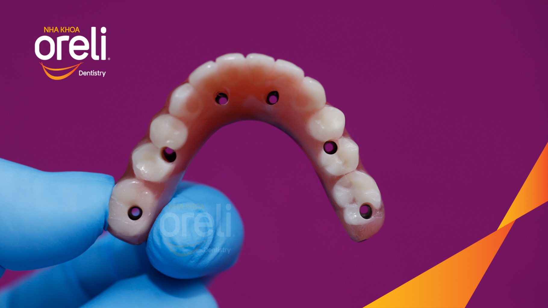 Thực hiện Nhổ răng trồng răng implant hàm dưới và hai răng hàm trên kéo dài 1 tuần tại Nha khoa Oreli Buôn Hồ