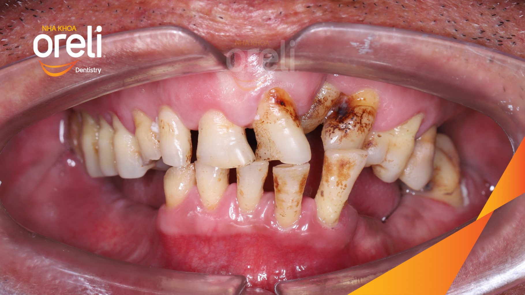 Kết quả sau 1 tuần: Phục hồi vững chắc hàm dưới tại Nha khoa Oreli Buôn Hồ