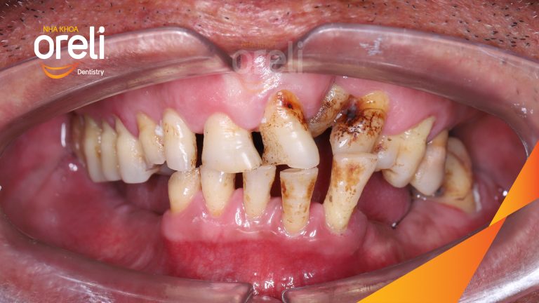 Phục Hình Implant Hàm Dưới Và 2 Răng Hàm Trên – Nha Khoa Oreli Buôn Hồ