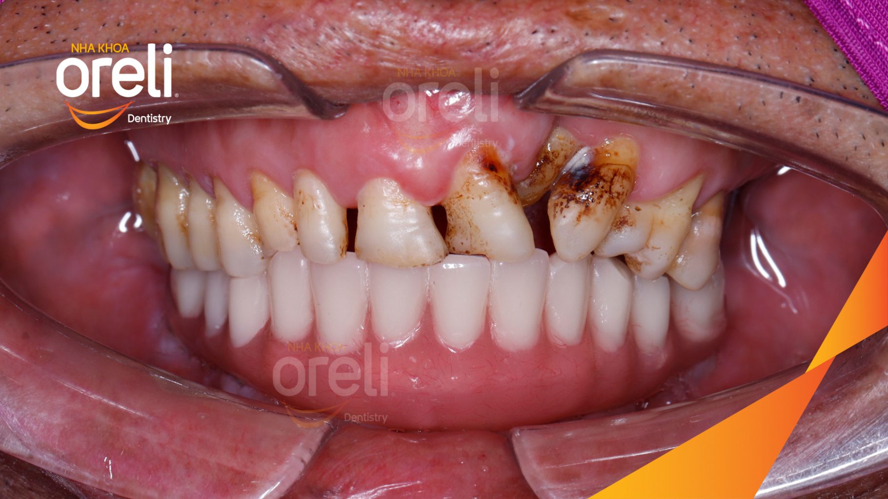 Kết quả đạt được sau 1 tuần - Phục hồi vững chắc hàm dưới tại Nha khoa Oreli Buôn Hồ