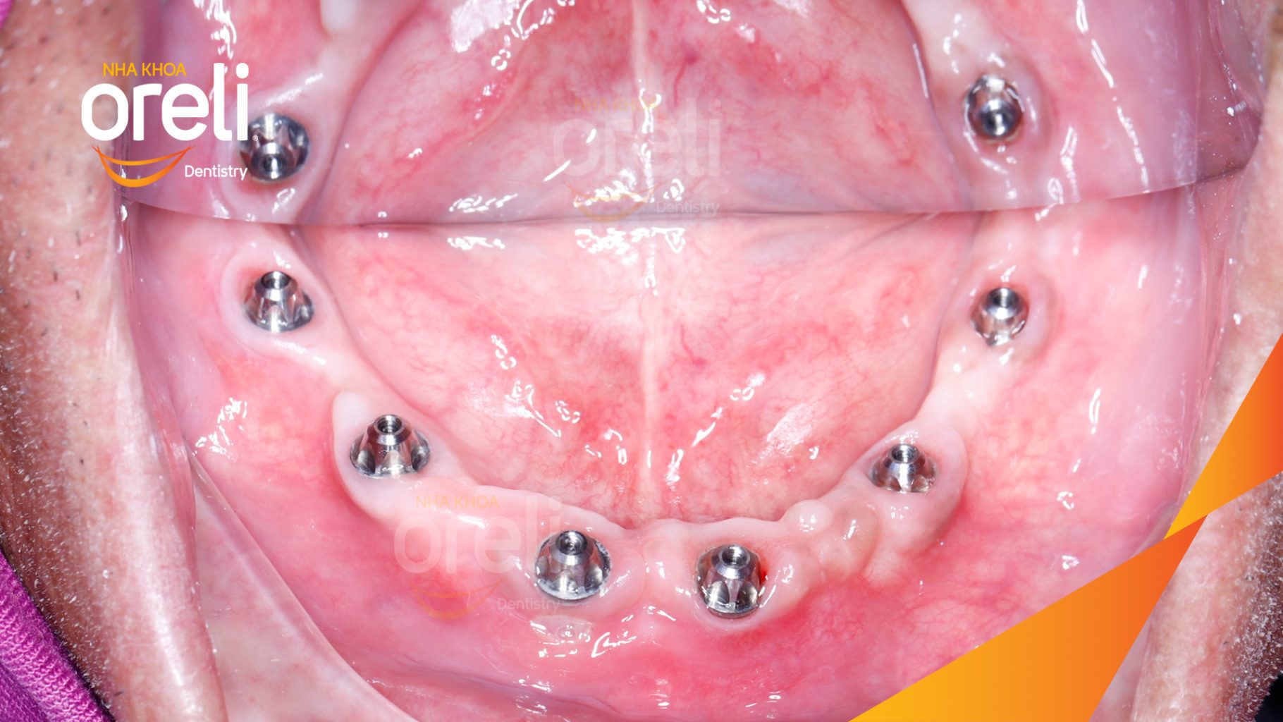 Trước điều trị: Mất răng vùng răng sau hàm dưới, các răng trước lung lay mất khả năng hồi phục tại Nha khoa Oreli Buôn Hồ