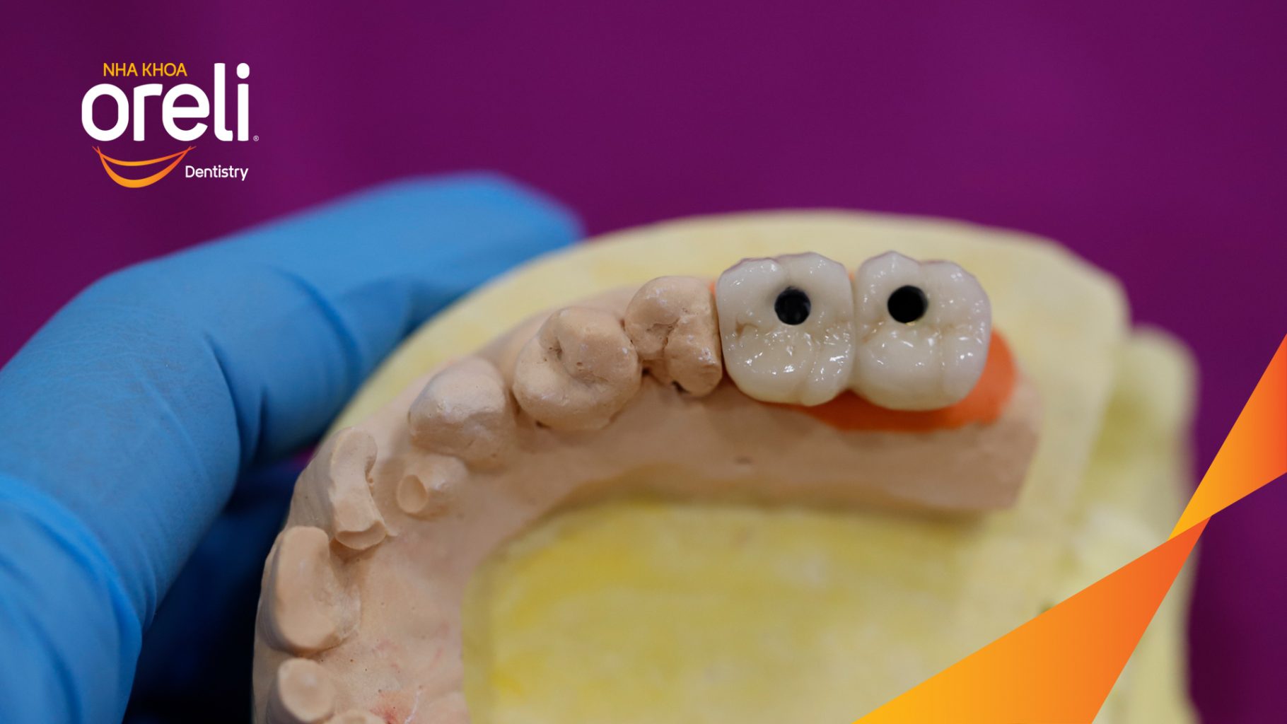 Mất răng vùng răng sau hàm dưới, các răng trước lung lay mất khả năng hồi phục trước khi điều trị tại Nha khoa Oreli Buôn Hồ