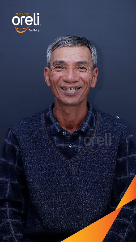 Quá trình Nhổ răng trồng răng implant hàm dưới và hai răng hàm trên trong 1 tuần tại Nha khoa Oreli Buôn Hồ