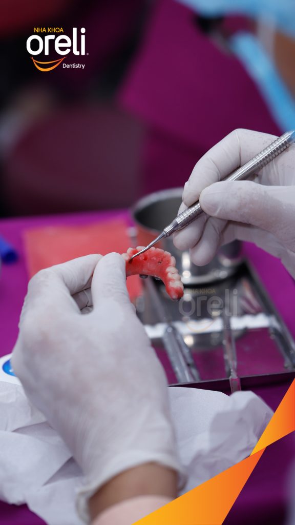 Kết quả đạt được sau 1 tuần - Phục hồi vững chắc hàm dưới tại Nha khoa Oreli Buôn Hồ