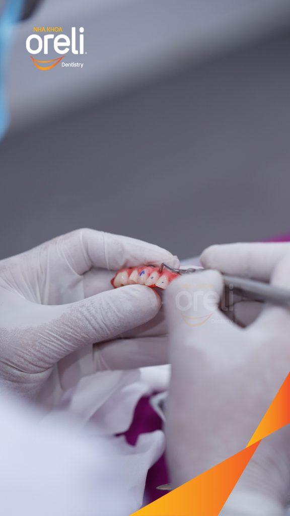 Kết quả sau 1 tuần: Phục hồi vững chắc hàm dưới tại Nha khoa Oreli Buôn Hồ