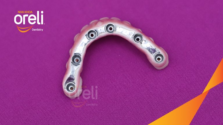 Phục Hình Implant Hàm Dưới Và 2 Răng Hàm Trên – Nha Khoa Oreli Buôn Hồ