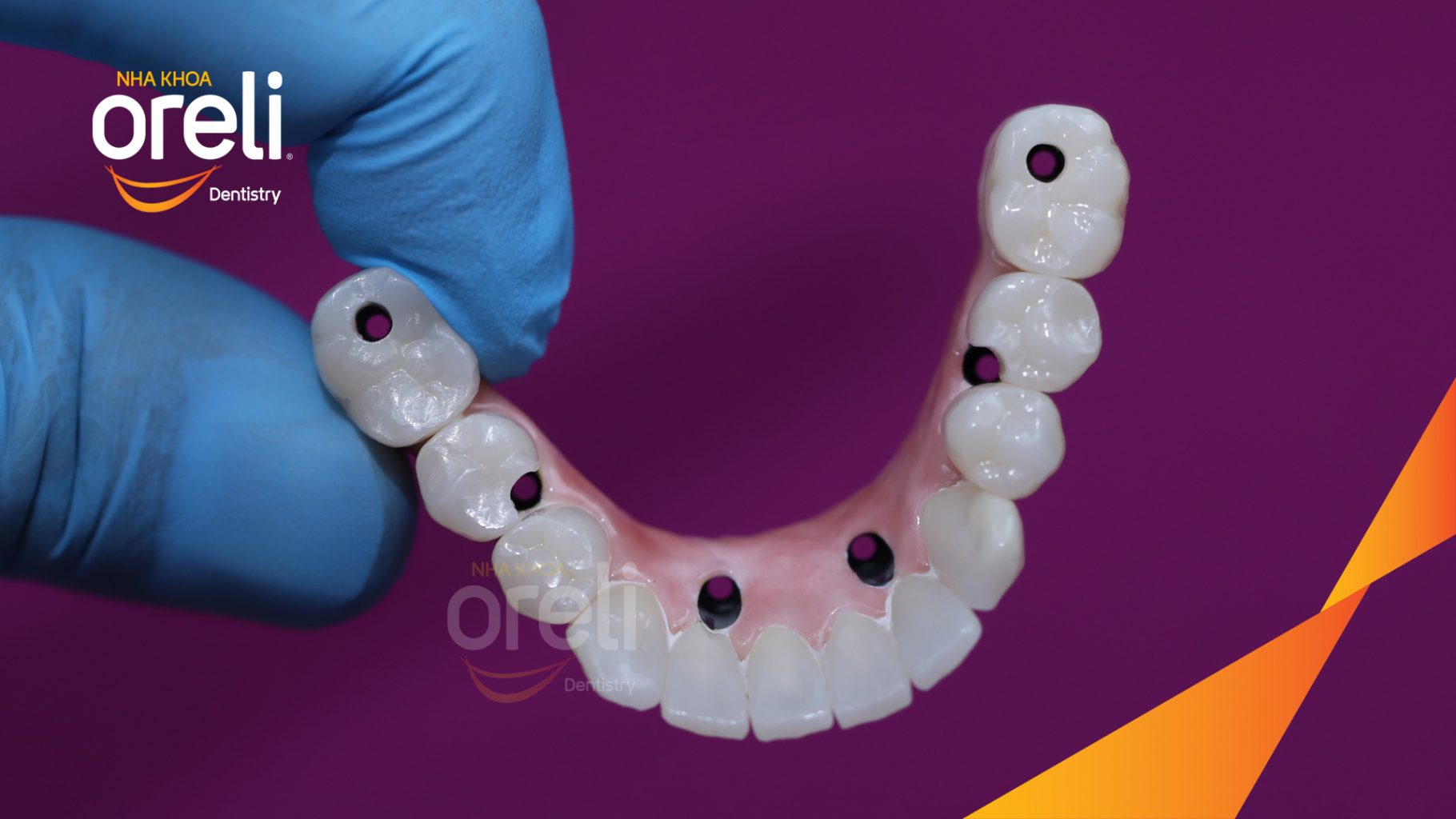 Thực hiện Nhổ răng trồng răng implant hàm dưới và hai răng hàm trên kéo dài 1 tuần tại Nha khoa Oreli Buôn Hồ