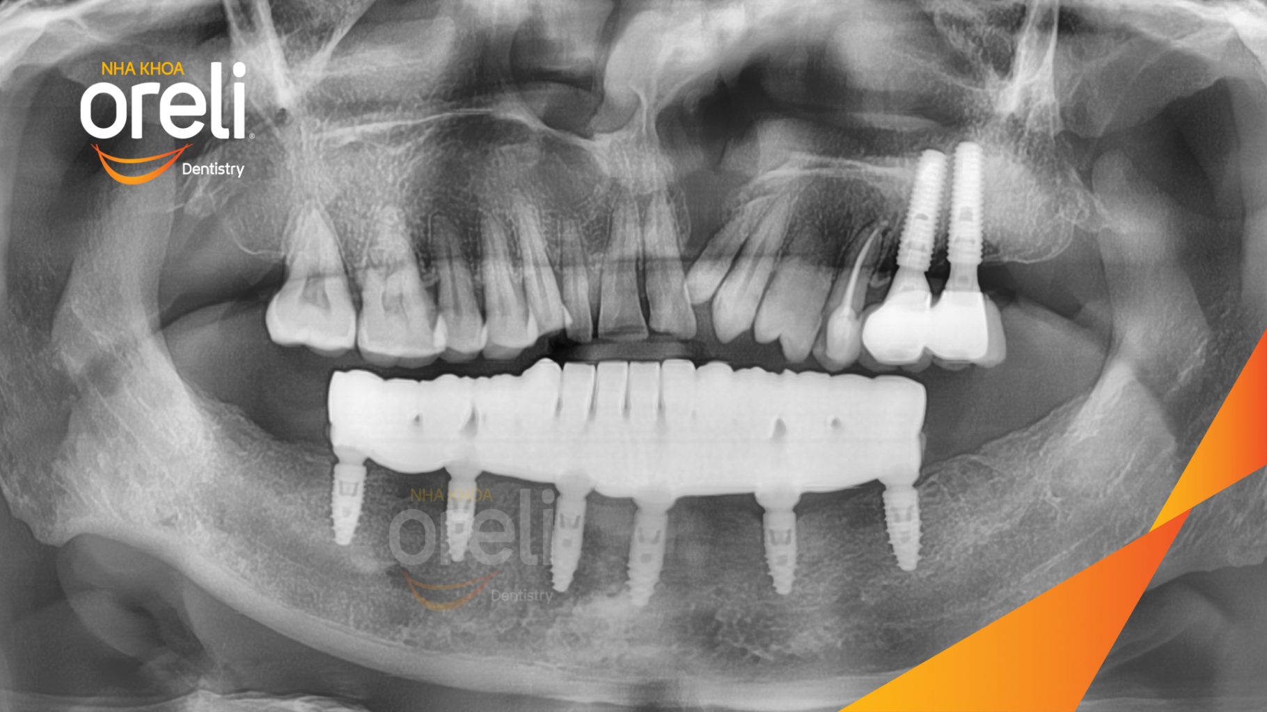 Quá trình Nhổ răng trồng răng implant hàm dưới và hai răng hàm trên trong 1 tuần tại Nha khoa Oreli Buôn Hồ