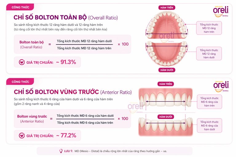 Chỉ số Bolton trong chỉnh nha là gì ?