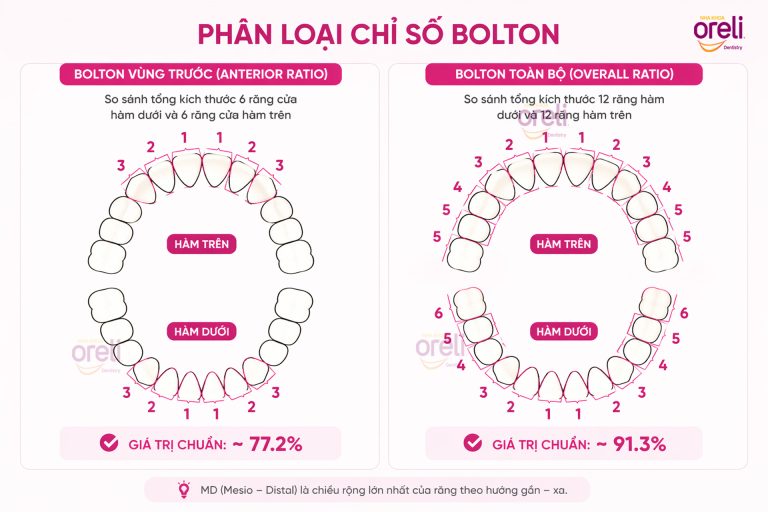 Chỉ số Bolton là gì? Nguyên nhân hở kẽ sau niềng răng