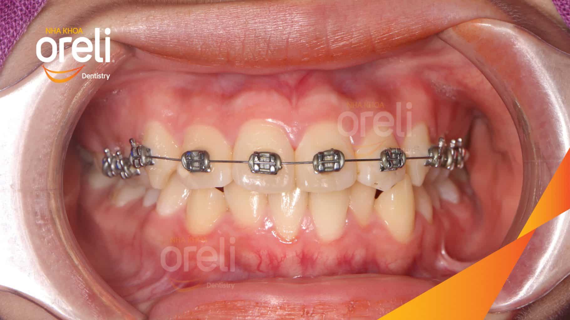 Quá trình Nhổ răng 4 chỉnh hô trong 24 tháng tại Nha khoa Oreli