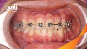 Chỉnh nha toàn diện (Giai đoạn 2)