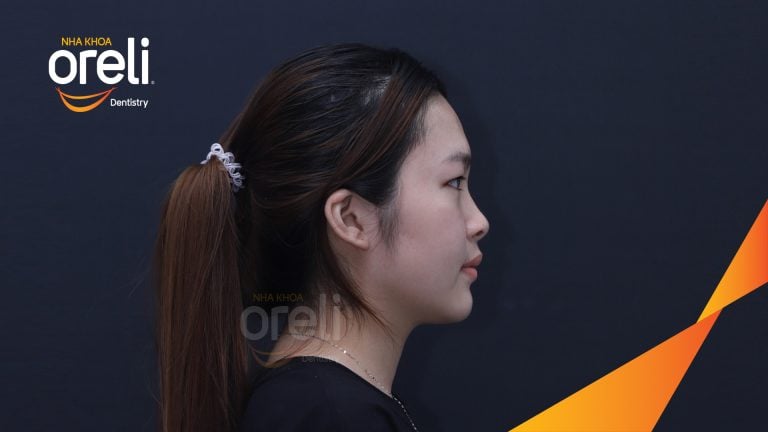 Trước – Sau niềng răng hô: Thay đổi rõ sau 24 tháng tại nha khoa Oreli